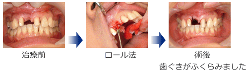 歯周形成外科・症例1