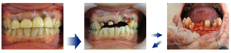 歯周形成外科・症例2