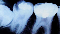 レントゲン撮影で詰め物の下にむし歯を見つける
