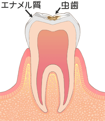 Ｃ１（エナメル質までの虫歯）