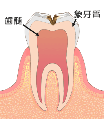 Ｃ２（象牙質まで進んだ虫歯）